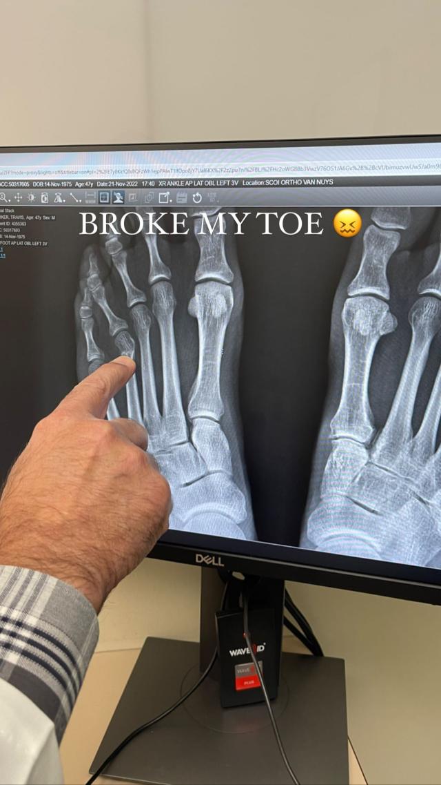 Travis Barker sofre fratura no dedo do pé / Travis Barker suffers broken toe